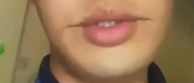 男子吃燒烤被燙出微笑唇